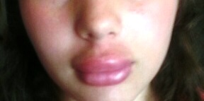 Swollen Lips